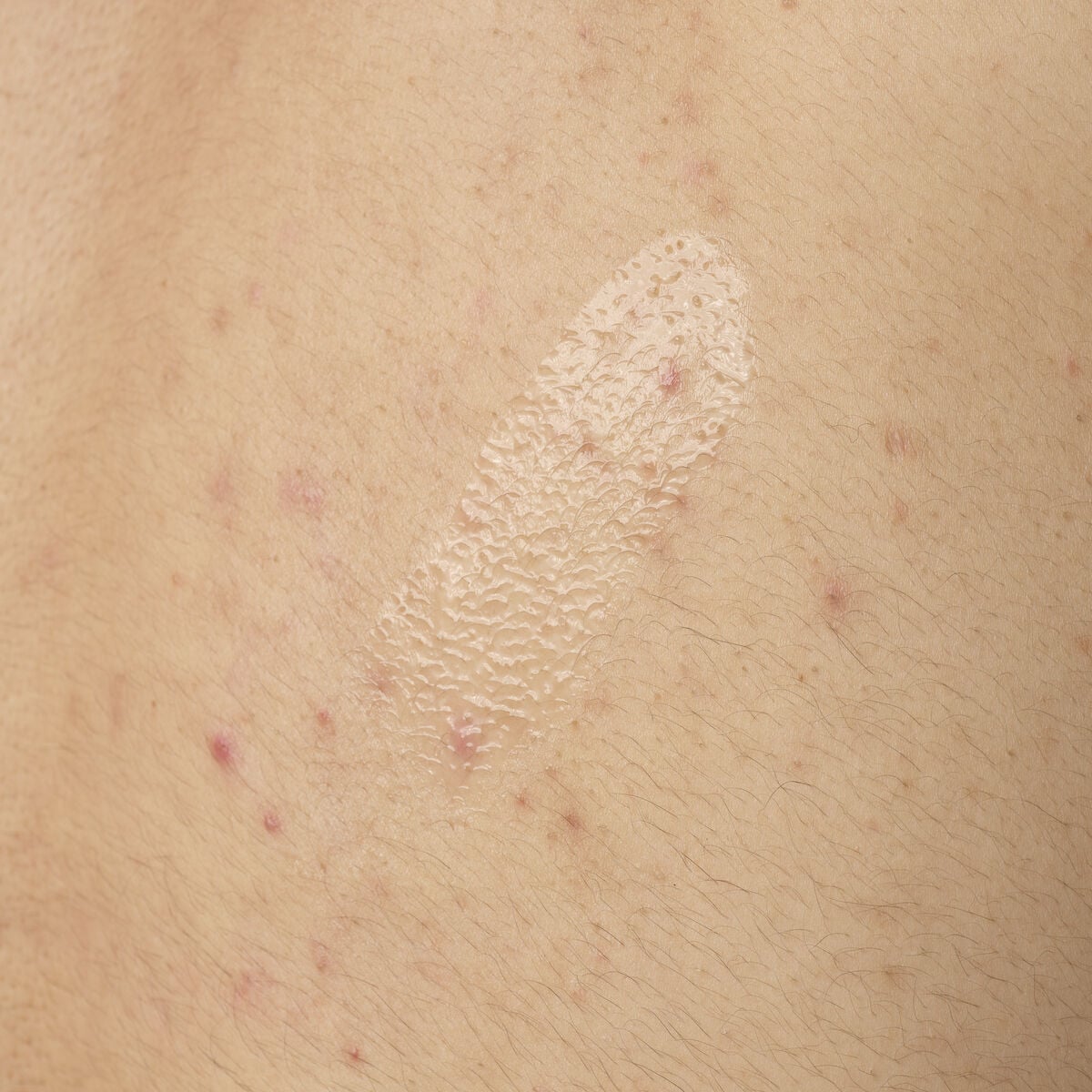 salicylic-acid-0-5-body-serum-p7 ORD-salicylic-acid-05-body-240ml-application.jpg