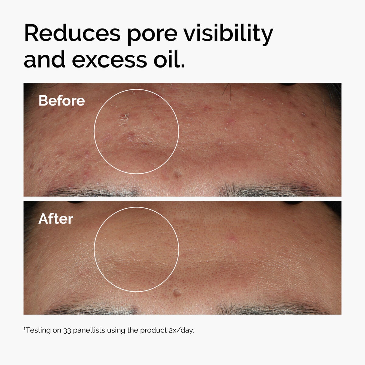niacinamide-10-zinc-1-f2 ord-niacinamide-zinc-blemish-serum-before-after-pores.jpg