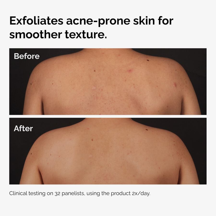 the-body-care-collection-z8 ord-salicylic-acid-body-serum-before-after-graphic-NA.jpg